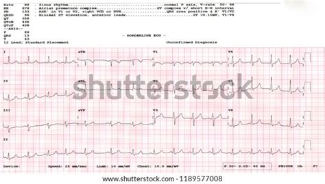 Cardiogram Waveform Ekg Showing Borderline Ekg Stock Photo Hot Sex