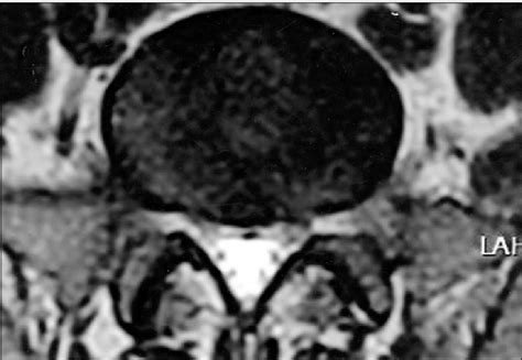 Figure 2 From Peripheral Neuropathy In A Patient With Churg Strauss