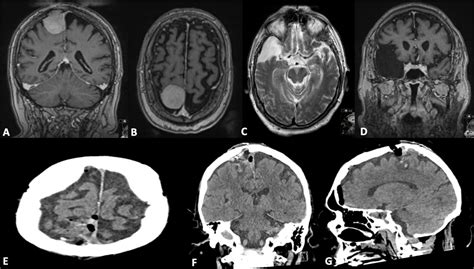 Infection Of A Sylvian Galassi Ii Arachnoid Cyst After Craniotomy For