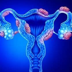 Endometriosis | IFLScience