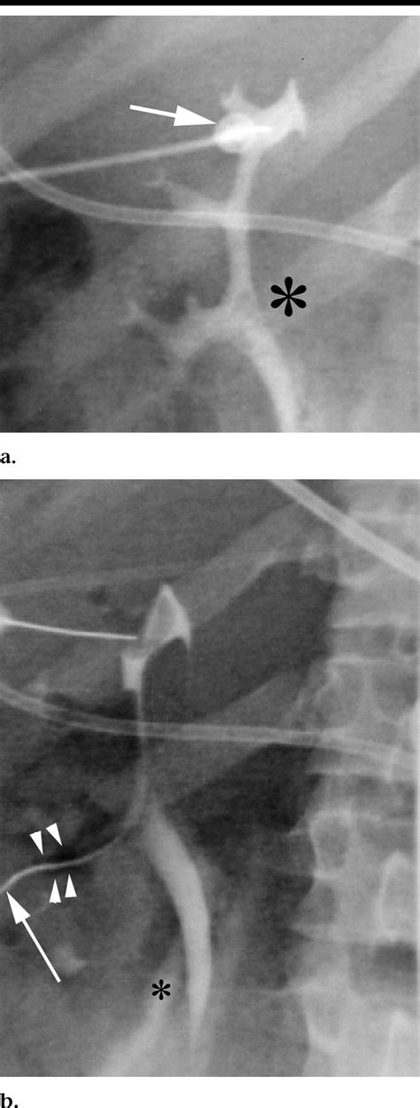 A 20 Right Posterior Oblique Fluoroscopic Image Of The Left Kidney