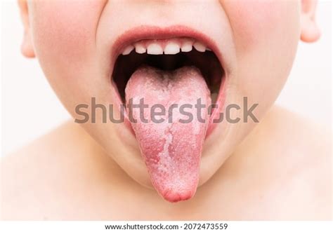 Geographic Tongue Disease Cropped Shot Small Stock Photo 2072473559 | Shutterstock