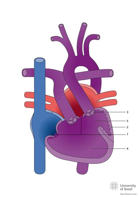 Double Inlet Left Ventricle (DILV) - Tiny Tickers