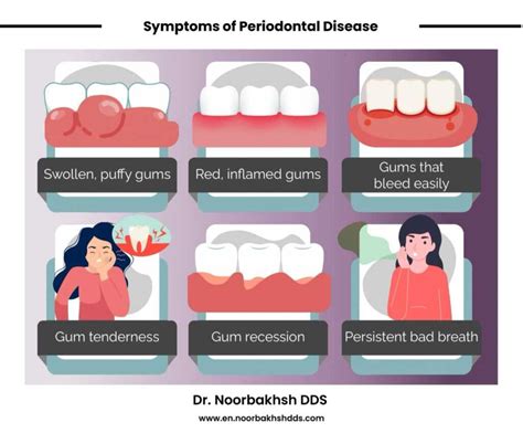 The Stages of Periodontal Disease (Gum Disease)