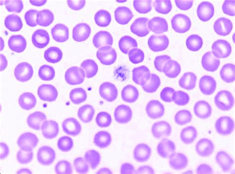 Peripheral Smear Showing Thrombocytopenia With Large Platelets