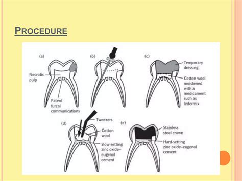 Difference Between Pulpotomy And Pulpectomy Ppt