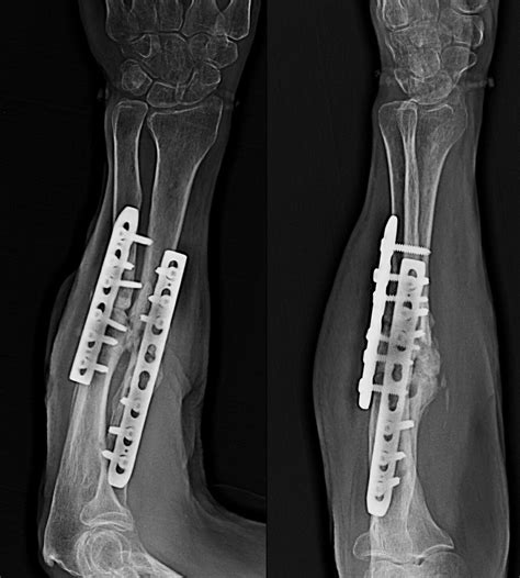 posttraumatic malunion  union treatment trishla ortho