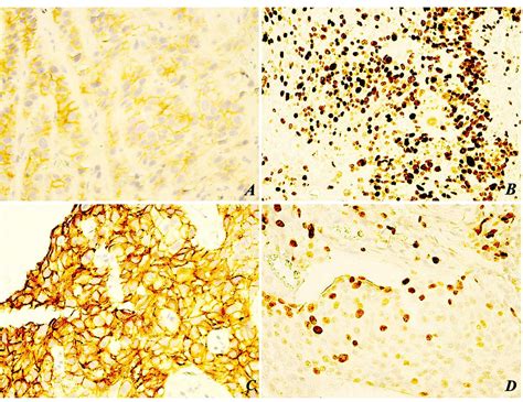 Loss Of E Cadherin Expression Correlates With Ki In Head And Neck