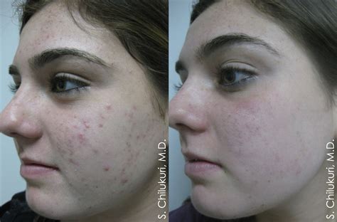 Acne Treatment Archives Refresh Dermatology