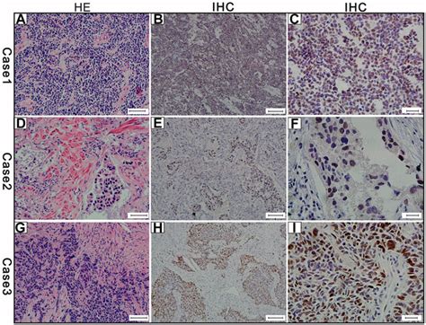 POR MYCL1 Amplification And Expression Of L Myc And C Myc In