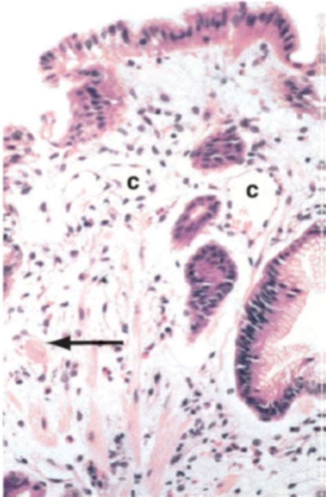 Gastric Antral Vascular Ectasia A Case Report And Literature Review