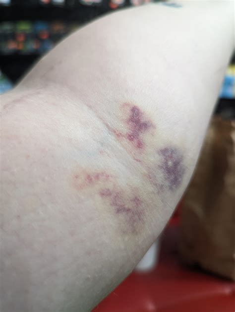 Healing blood work bruise : r/bruises