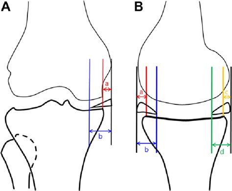 Schematic View Of Meniscal Allograft Extrusion On Magnetic Resonance