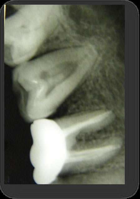 B Preoperative Radiograph Revealing Irregular Morphology Of Tooth