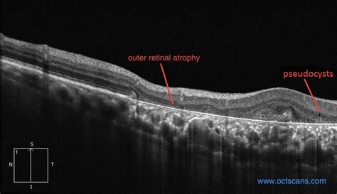 Age-Related Macular Degeneration - Optical Coherence Tomography Scans