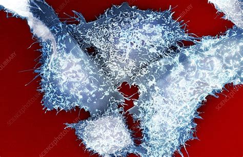 Prostate Cancer Cells SEM Stock Image C001 8167 Science Photo