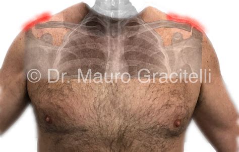 Dor Acromioclavicular Dr Mauro Gracitelli