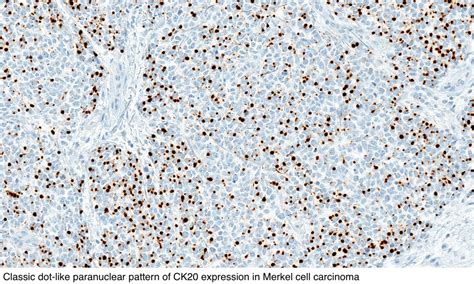 Pathology Outlines Merkel Cell Carcinoma