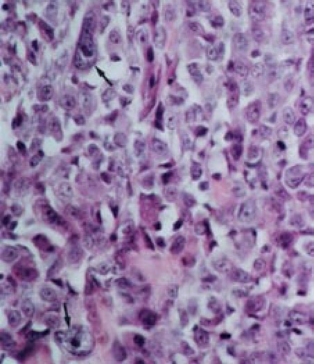 Section Of Malignant Fibrous Histiocytoma From Subcutaneous Tissue