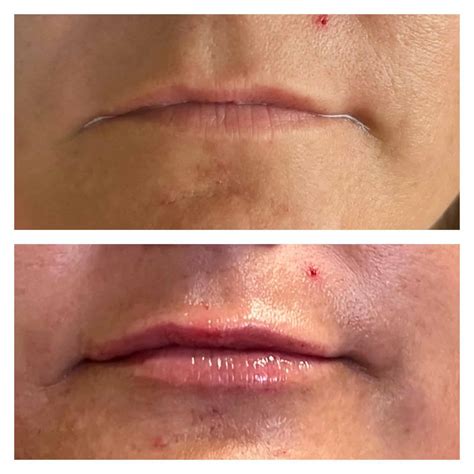 Transform Your Look With Dermal Fillers In Toledo Ohio