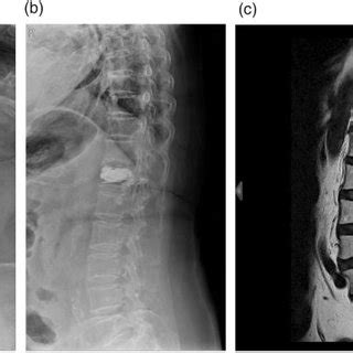 Case One Year Postoperative Radiographs No Implant Loosening Or