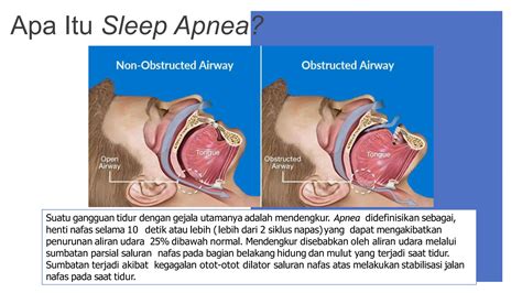 Tatalaksana Mendengkur Dan Gangguan Tidur Ppt Free Download