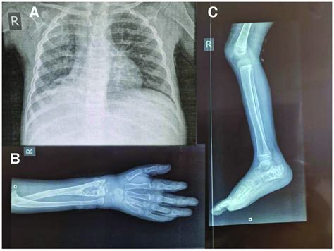 Plain X-ray of the spine. | Download Scientific Diagram