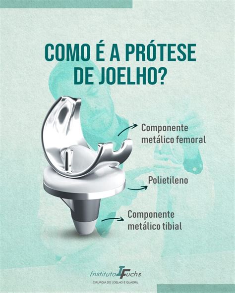 Como é a prótese de joelho Tratamento de Joelho e Quadril em Curitiba