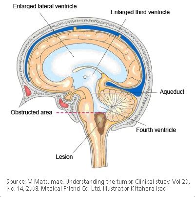 Obstructive Hydrocephalus | Pacific Adult Hydrocephalus Center