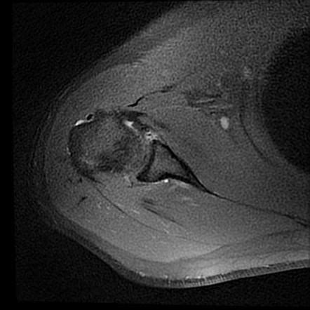 Anterior glenohumeral instability - Hill-Sachs defect and Bankart lesion | Radiology Case ...