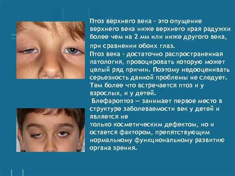 Птоз верхнего века: причины, классификация, диагностика, лечение