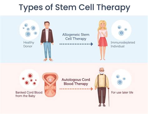 Stem cell therapy explained - Securicord