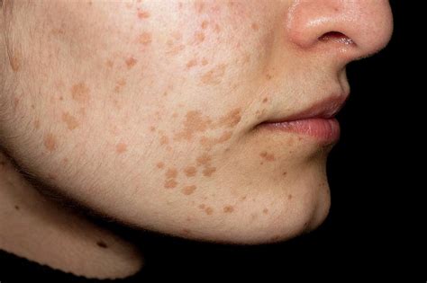 Flat Warts On The Face Photograph By Dr Harout Tanielianscience Photo Library