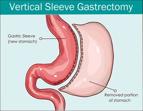 Types Of Weight Loss Surgery Comparison Blog Dandk