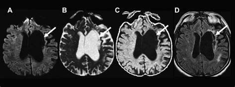 MR Diffusion Imaging in Ischemic Stroke | Radiology Key