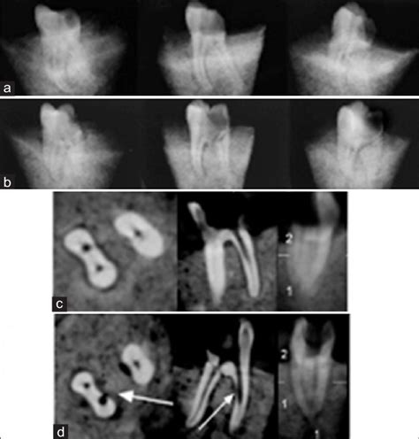 A B Conventional Periapical Radiographs Three Different