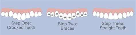 Same Day Braces Available. Augusta Orthodontic's Patient Guide