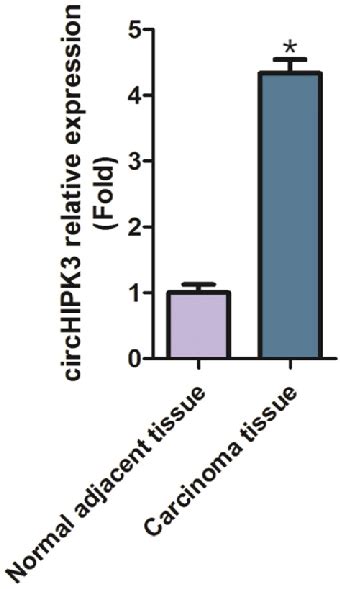 Expression Level Of Circhipk In The Carcinoma Tissues And Normal