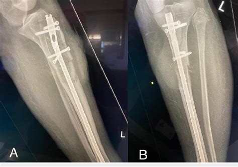 X-Ray left tibia and fibula (A-B) Lateral views of the left tibia and ...