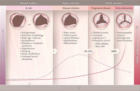 主动脉瓣狭窄——从有危险患者到重度瓣膜梗阻患者 Nejm医学前沿