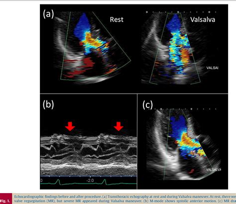 Figure 1 From A Successful Case Of Percutaneous Transluminal Septal