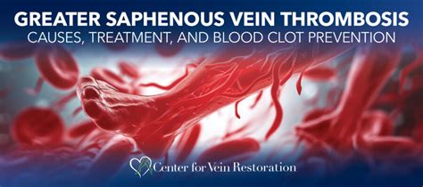 Greater Saphenous Vein Thrombosis: Causes, Treatment, and Blood Clot ...