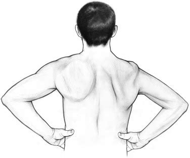 Scapular Winging | Musculoskeletal Key