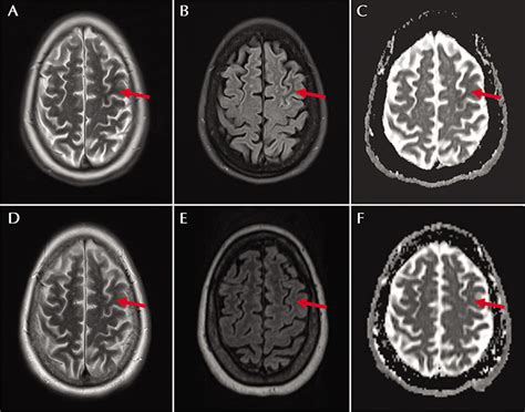 JLE Epileptic Disorders Location Atypical Lesions In Non Ketotic