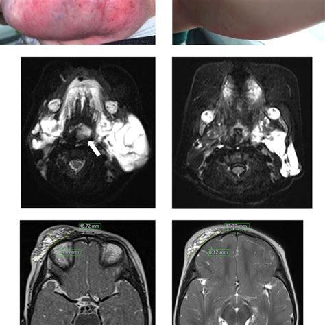 Patient 1 Had A Large Kaposiform Hemangioendothelioma On Her Left Upper