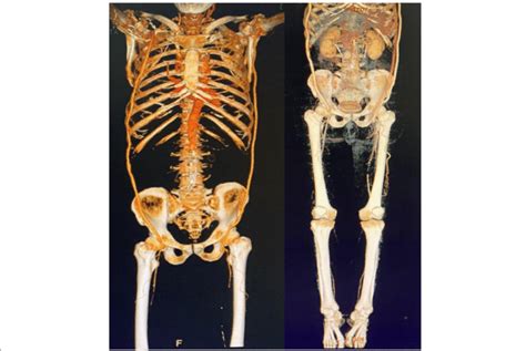 Postoperative Cta Examination Showing That The Left Lax Pf Bypass Is Download Scientific