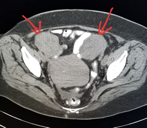 Ovarian Cancer Ct Scan With Contrast