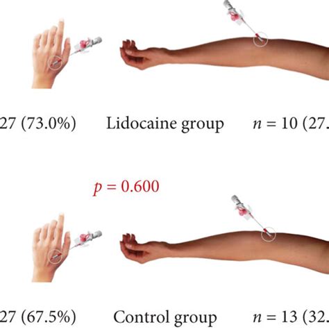 Distribution Of The Iv Cannulation Sites According To The Groups Download Scientific Diagram