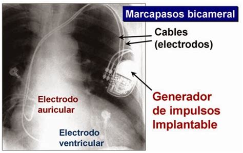 Marcapasos Card Acos