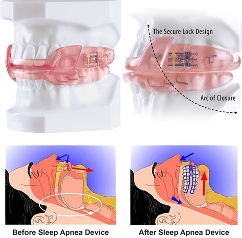 Sleep Apnea Smile Dental Care Dentist In Scotts Valley And Santa Cruz